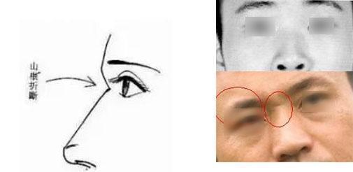 两眼之间山根有横纹_两眼睛中间山根面相分析_眼睛中间宽面相